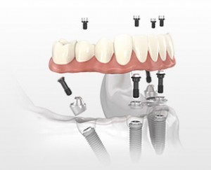 Plainfield Dental Care | Inlays and Onlays, Preventative Dentistry and CEREC reg  Same Day Crowns