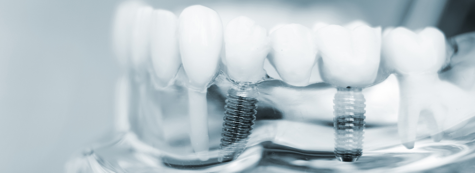 Plainfield Dental Care | Sedation Dentistry, Veneers and Laminates and iTero   Intraoral Scanner