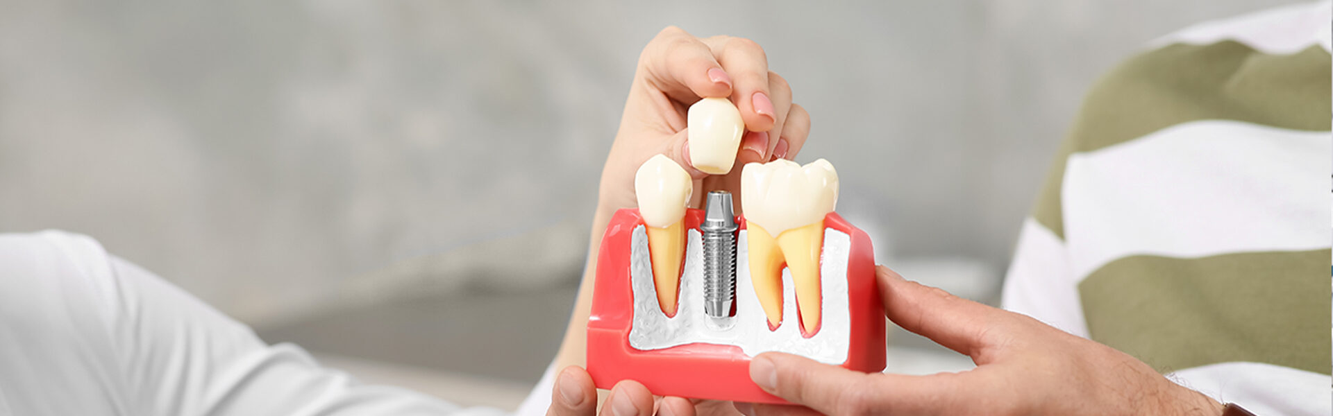 Dental Implants